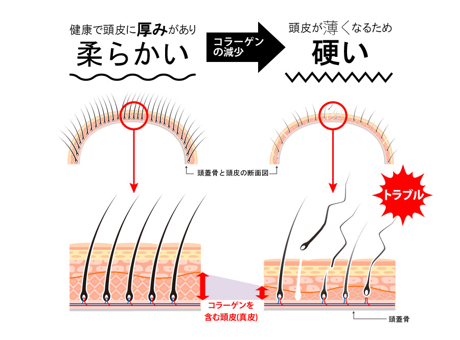 頭皮の薄い柔らかい