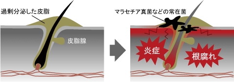 過剰分泌した皮脂によって毛穴が塞がれ、雑菌が繁殖し炎症を起こす。